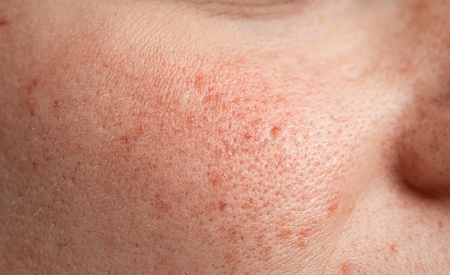 pele sensivel e vermelha