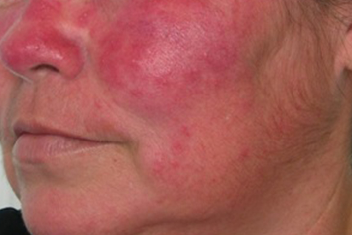 Guia Completo: Como Identificar e Tratar os Tipos de Vermelhidão na Pele