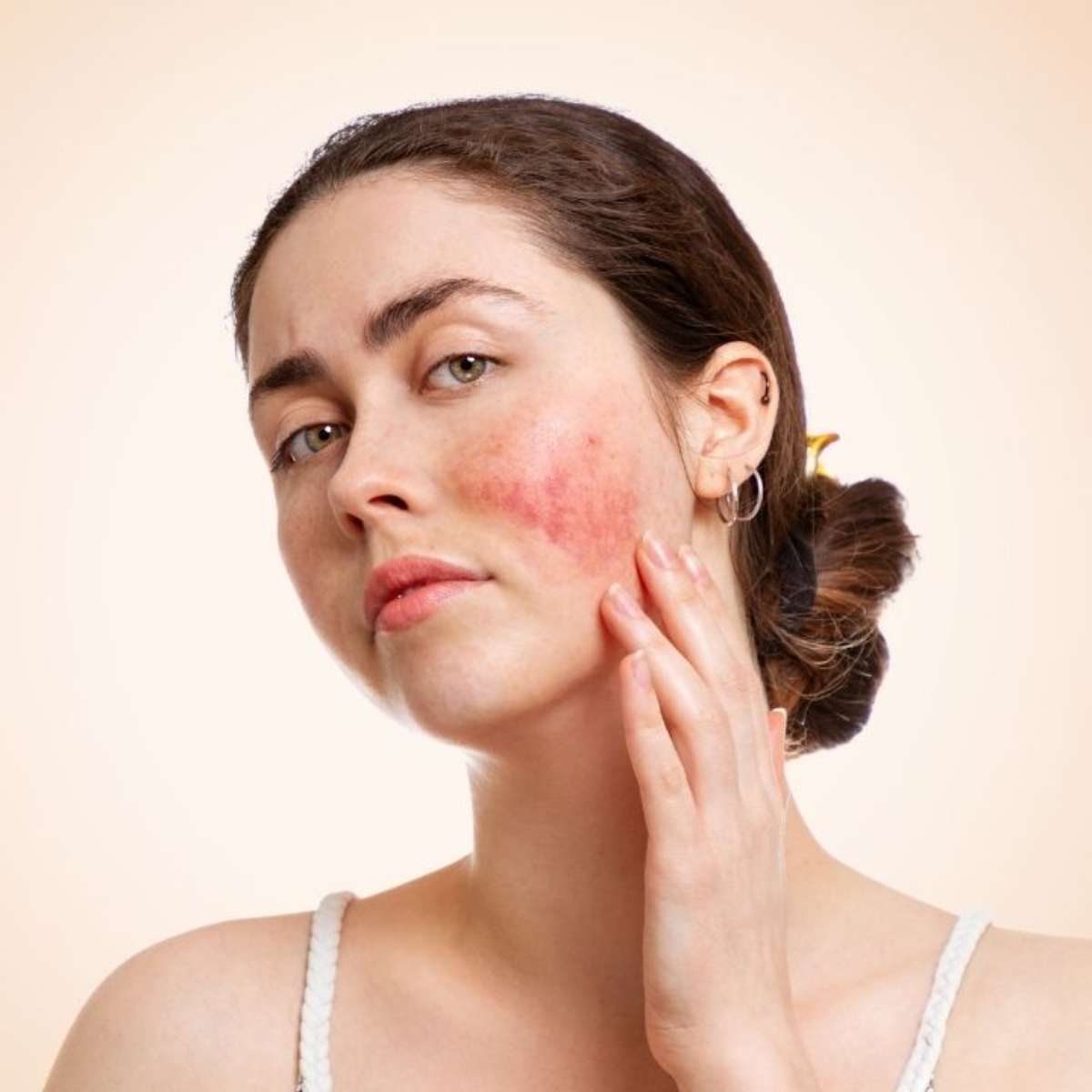 Guia Completo: Como Identificar e Tratar os Tipos de Vermelhidão na Pele