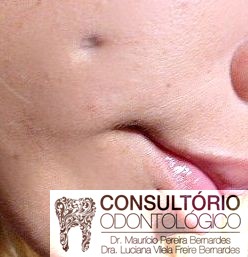 5 ideias de títulos: Os Perigos Ocultos do Piercing na Bochecha: Um Guia Completo; Piercing de Covinha: Tradicional vs. Microdermal - Qual o Melhor para Você?; Guia Essencial de Cuidados Pós-Piercing na Bochecha para uma Cicatrização Saudável; Anatomia Facial e Piercing na Bochecha: Entenda os Riscos e Estruturas Vitais; Titânio G23 e Outros Materiais: Escolhendo a Joia Certa para seu Piercing na Bochecha