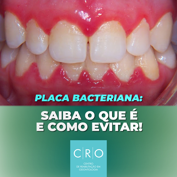 Placa Bacteriana vs. Tártaro: Entenda as Diferenças e Como Prevenir