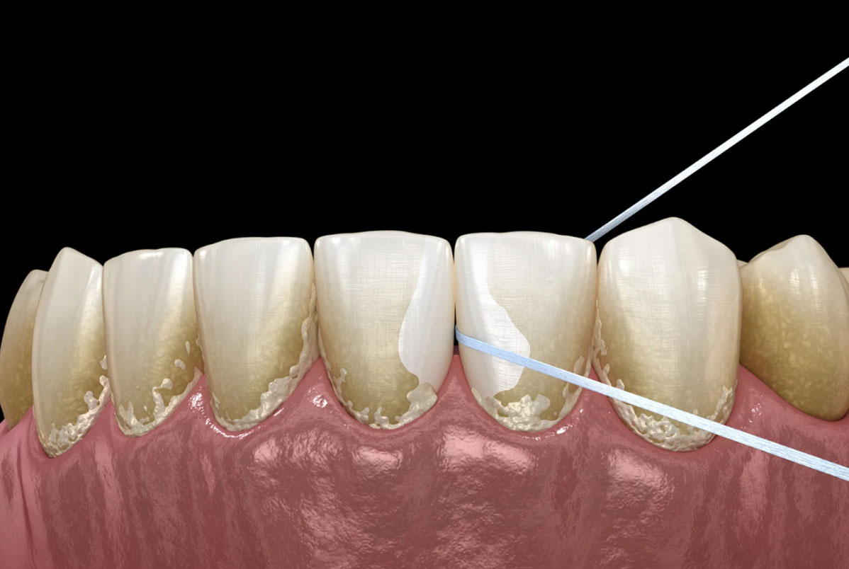 Guia Completo para Remover a Placa Bacteriana em Casa e no Dentista