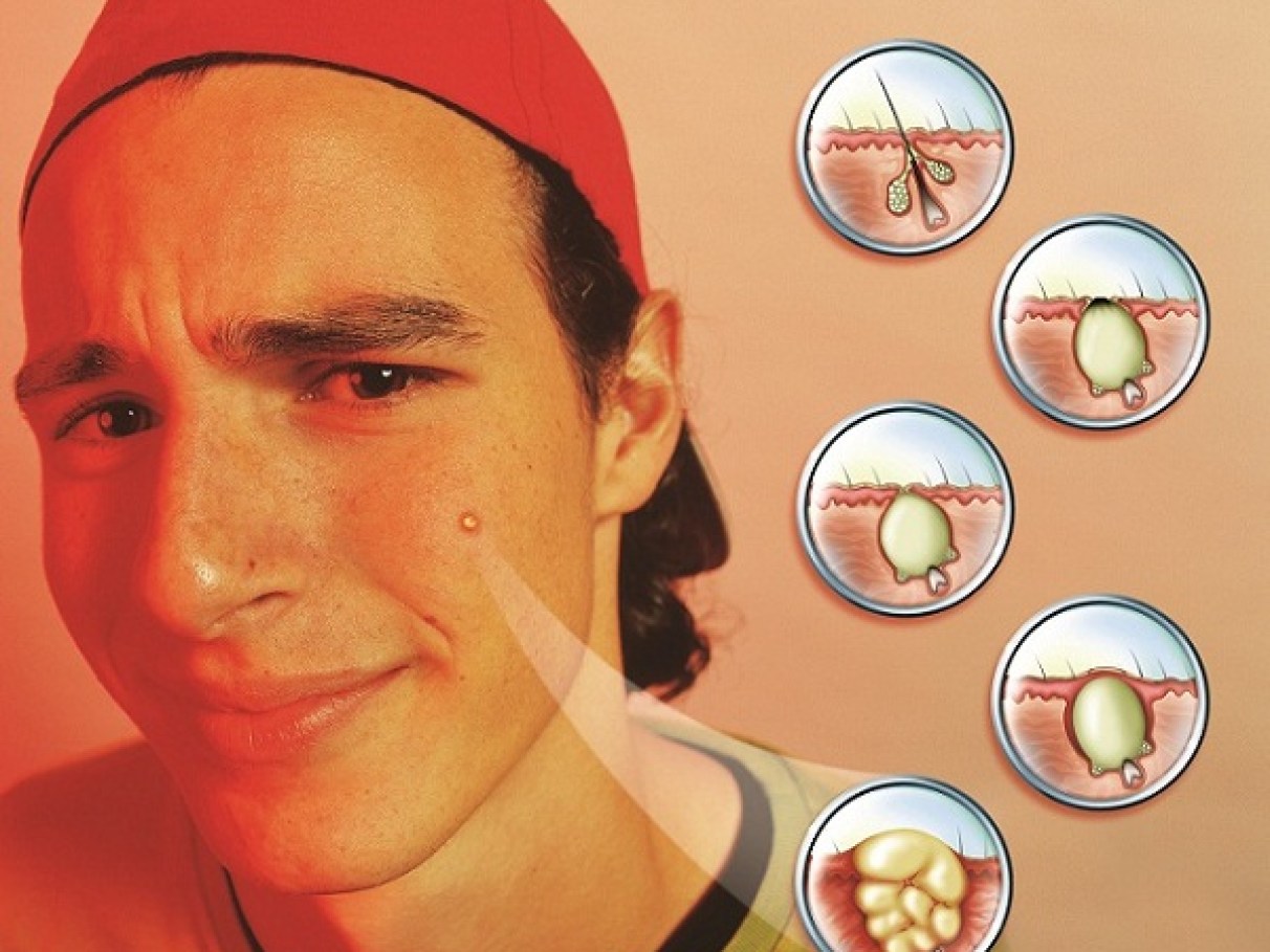 porque nascem espinhas