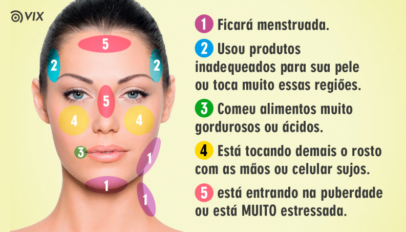 Acne Hormonal: Causas