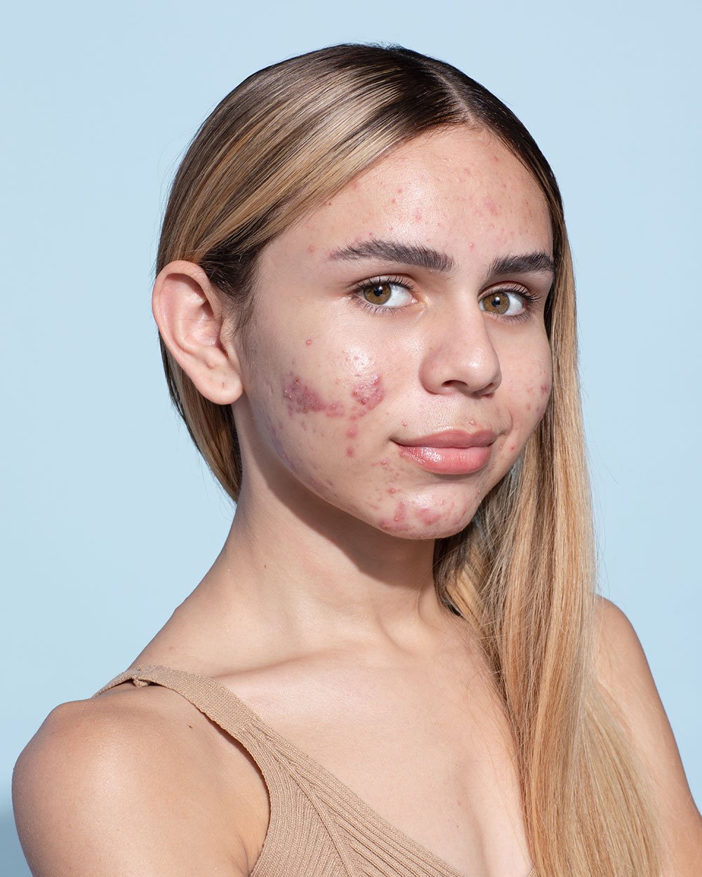 Mitos e Verdades sobre a Dieta e a Acne