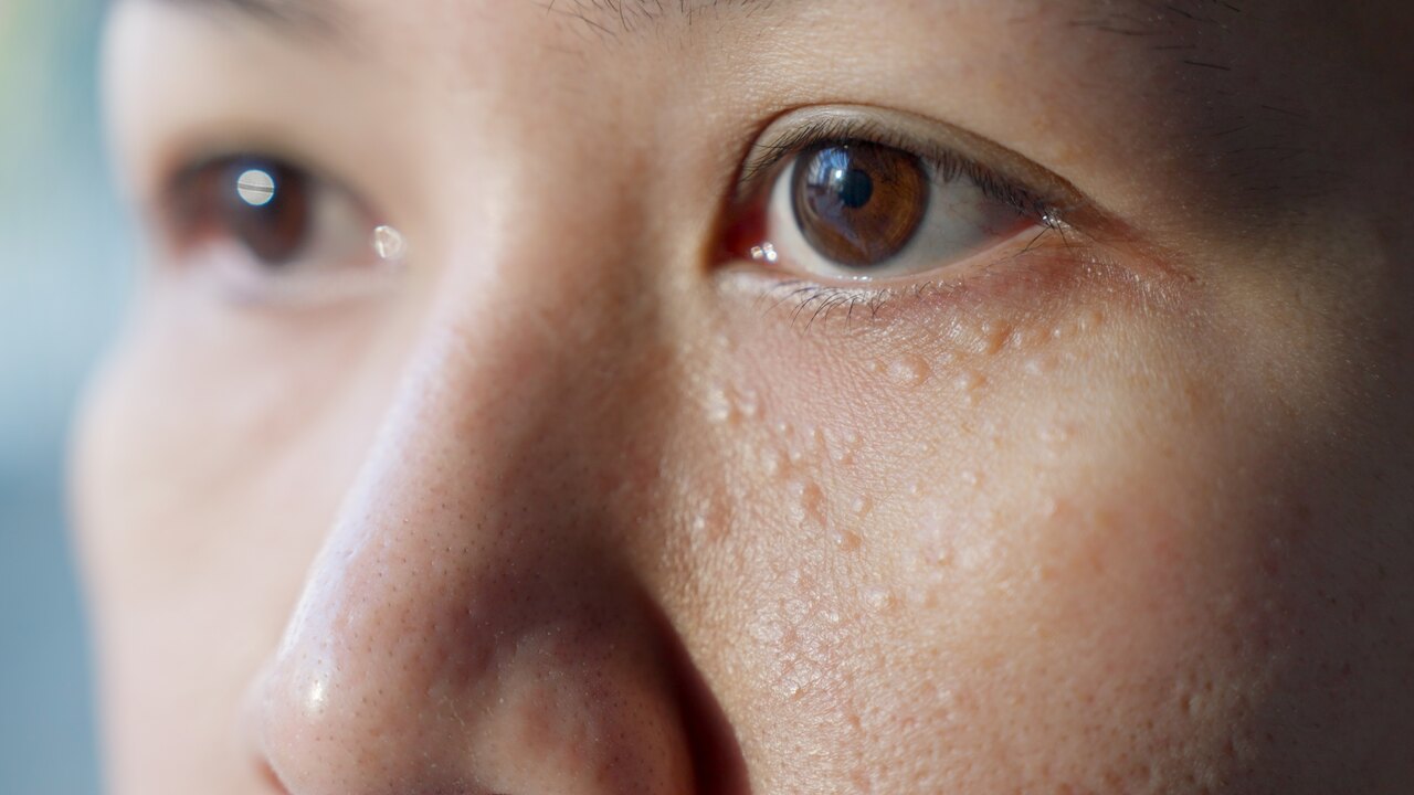 porque nascem espinhas