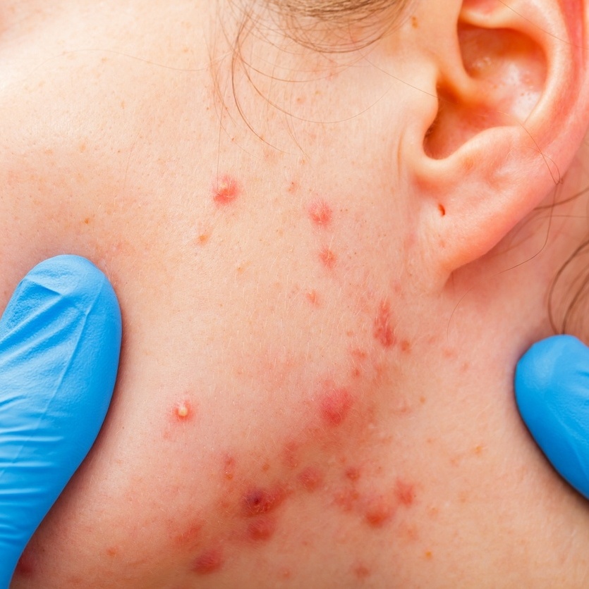 Acne Hormonal: Causas