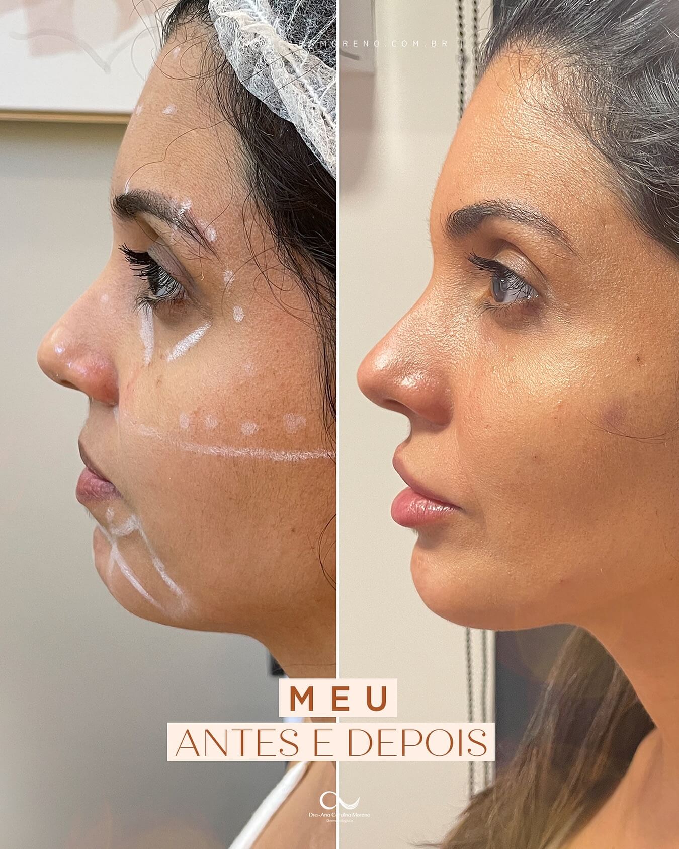 Preenchimento de queixo e mandíbula valor