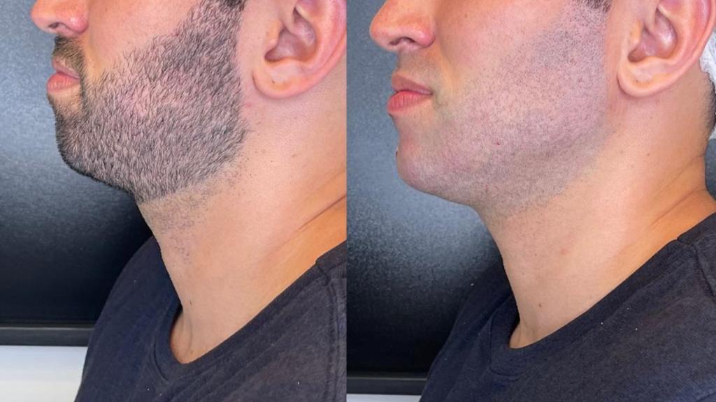 ideias preenchimento queixo mandíbula antes depois
