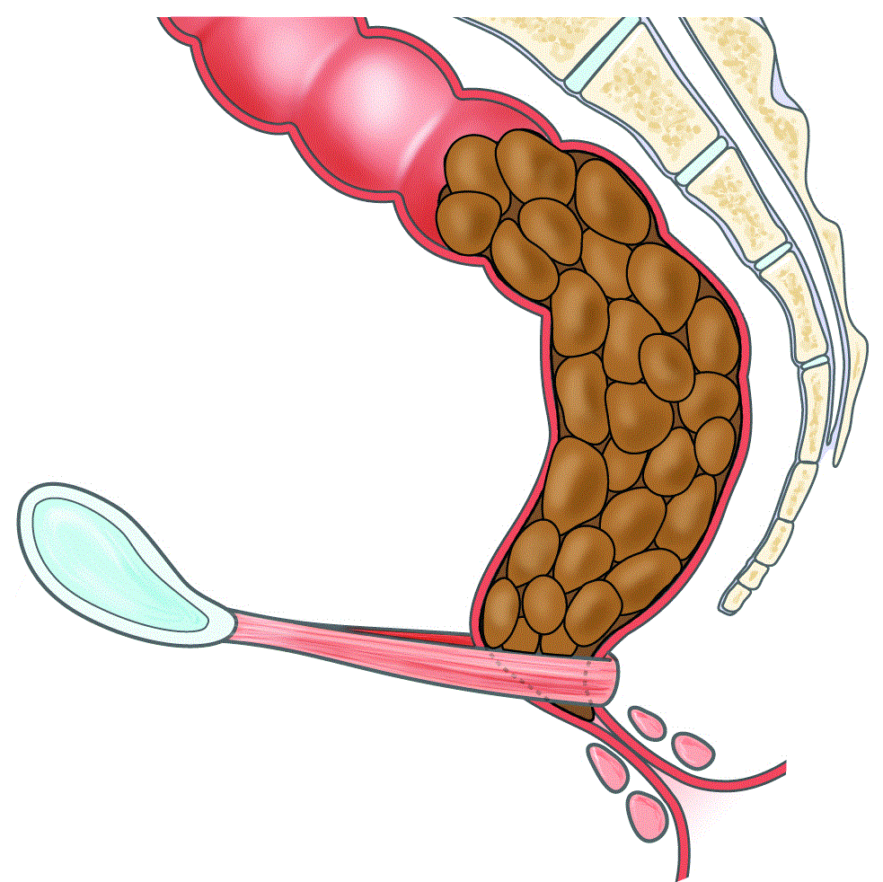Laxantes Naturais vs. Medicamentos: Qual a Melhor Opção para Constipação?