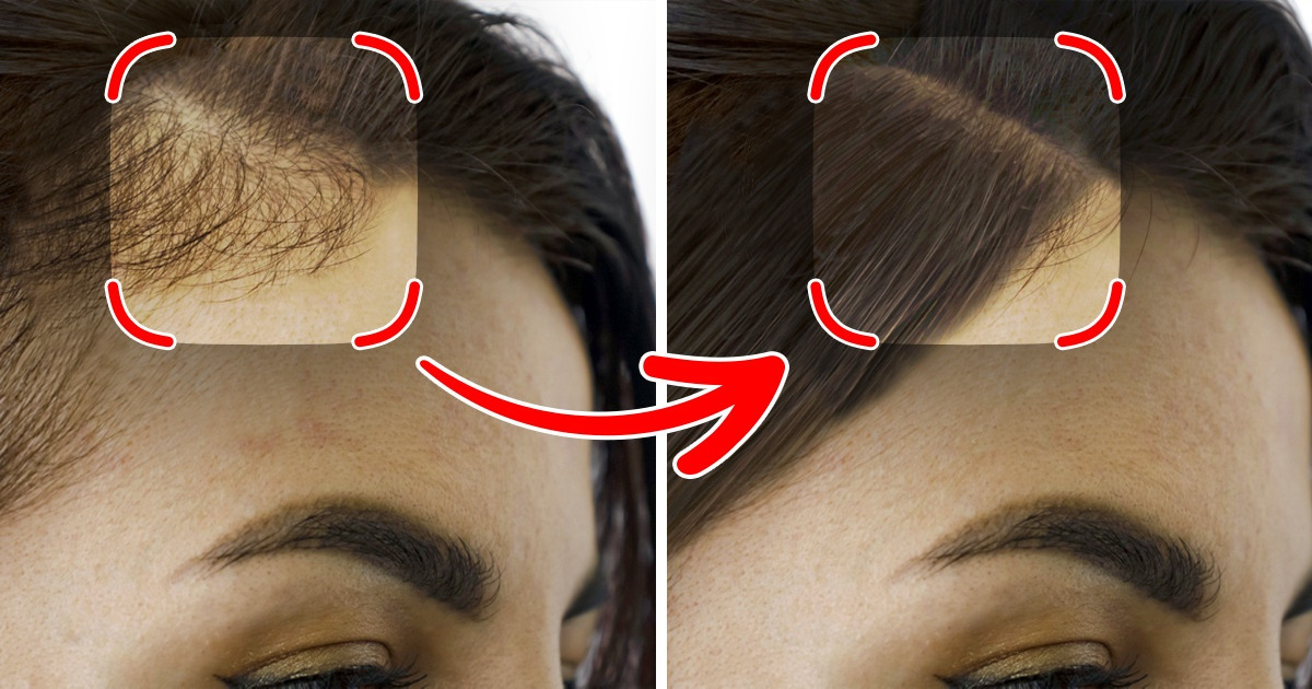 Menopausa e queda capilar: como a reposição hormonal ajuda?