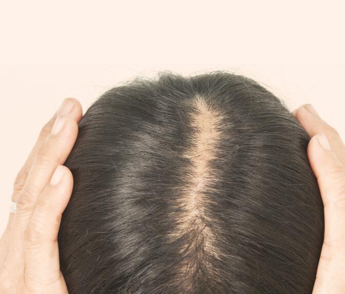 Menopausa e queda capilar: como a reposição hormonal ajuda?
