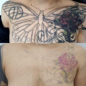 preço remoção tatuagem 2026