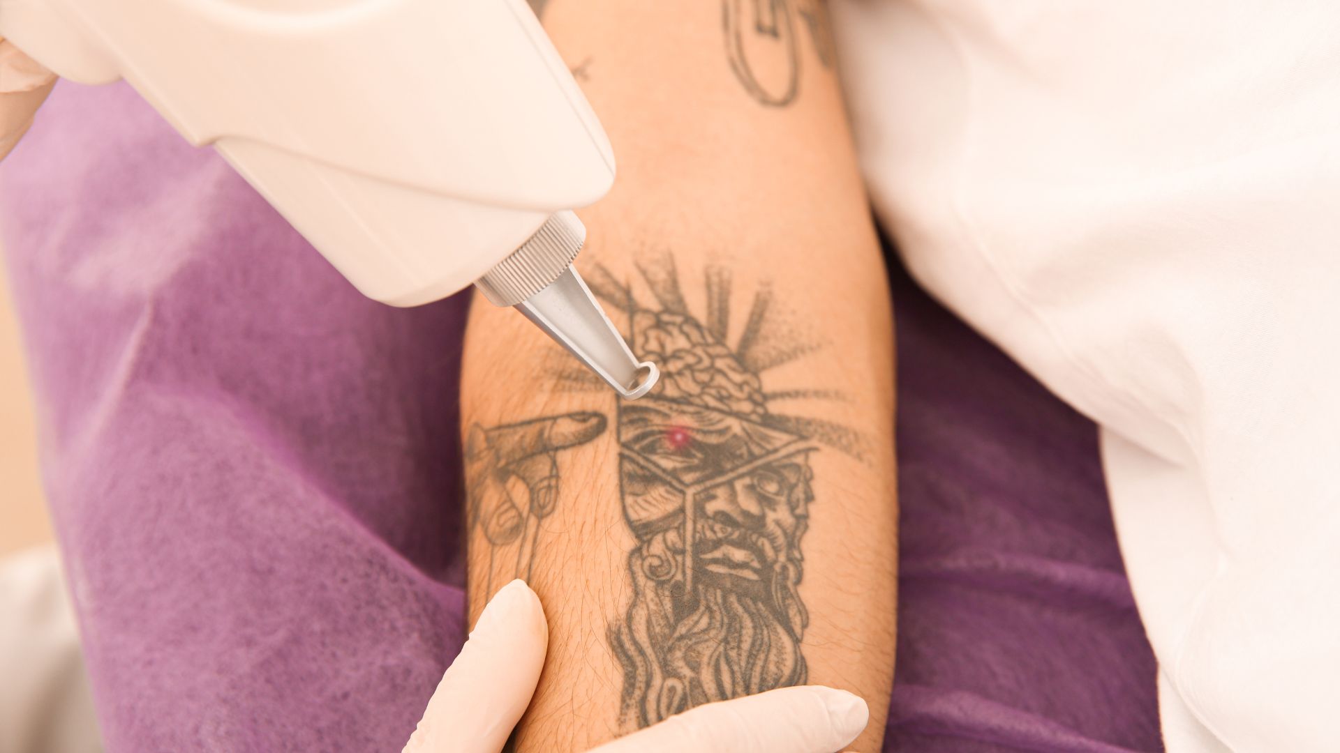 custo médio remoção tatuagem a laser