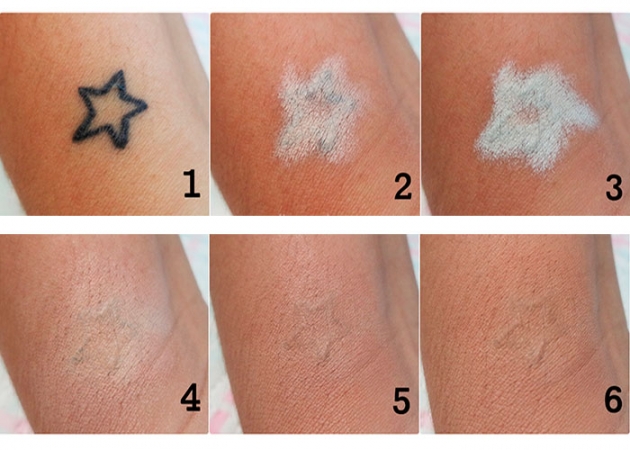 preço remoção tatuagem 2026