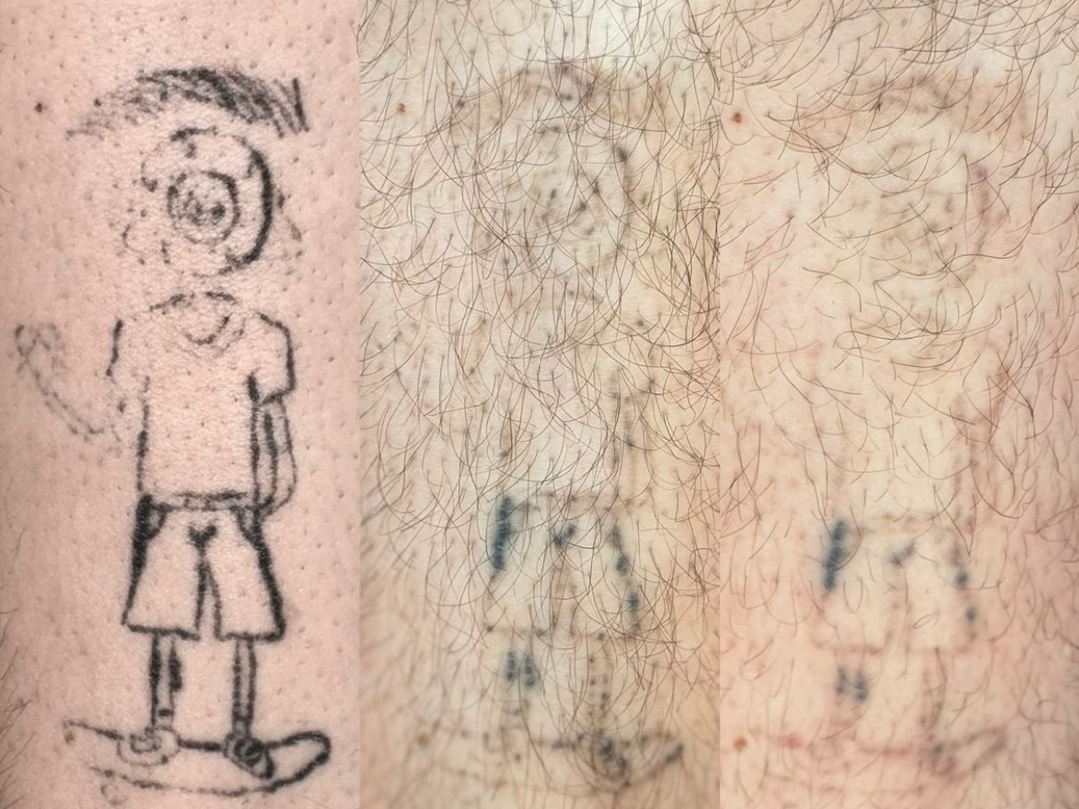 custo médio remoção tatuagem a laser