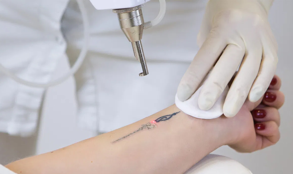 quanto custa apagar tatuagem