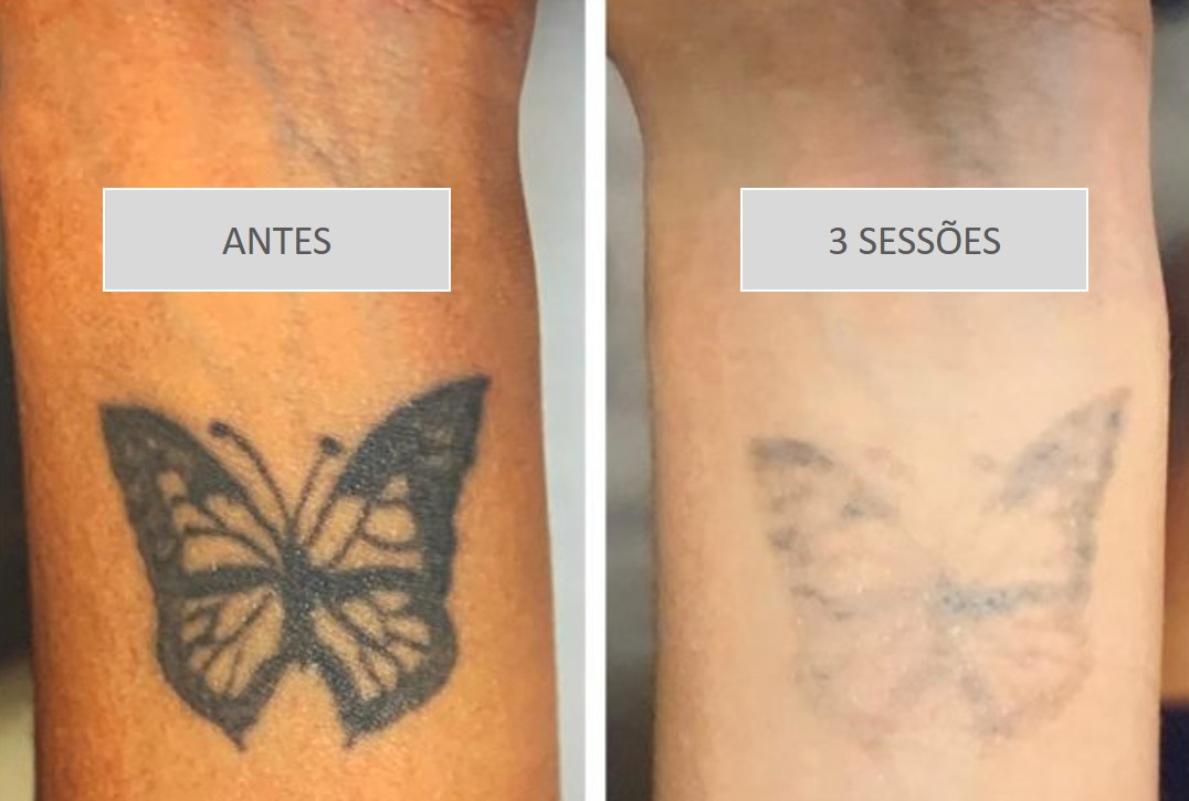 valor sessão remoção tatuagem