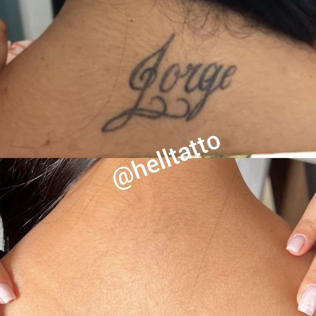 melhor método remoção tatuagem
