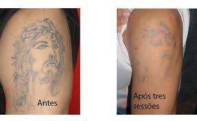 remoção de tatuagem a laser quantas sessões