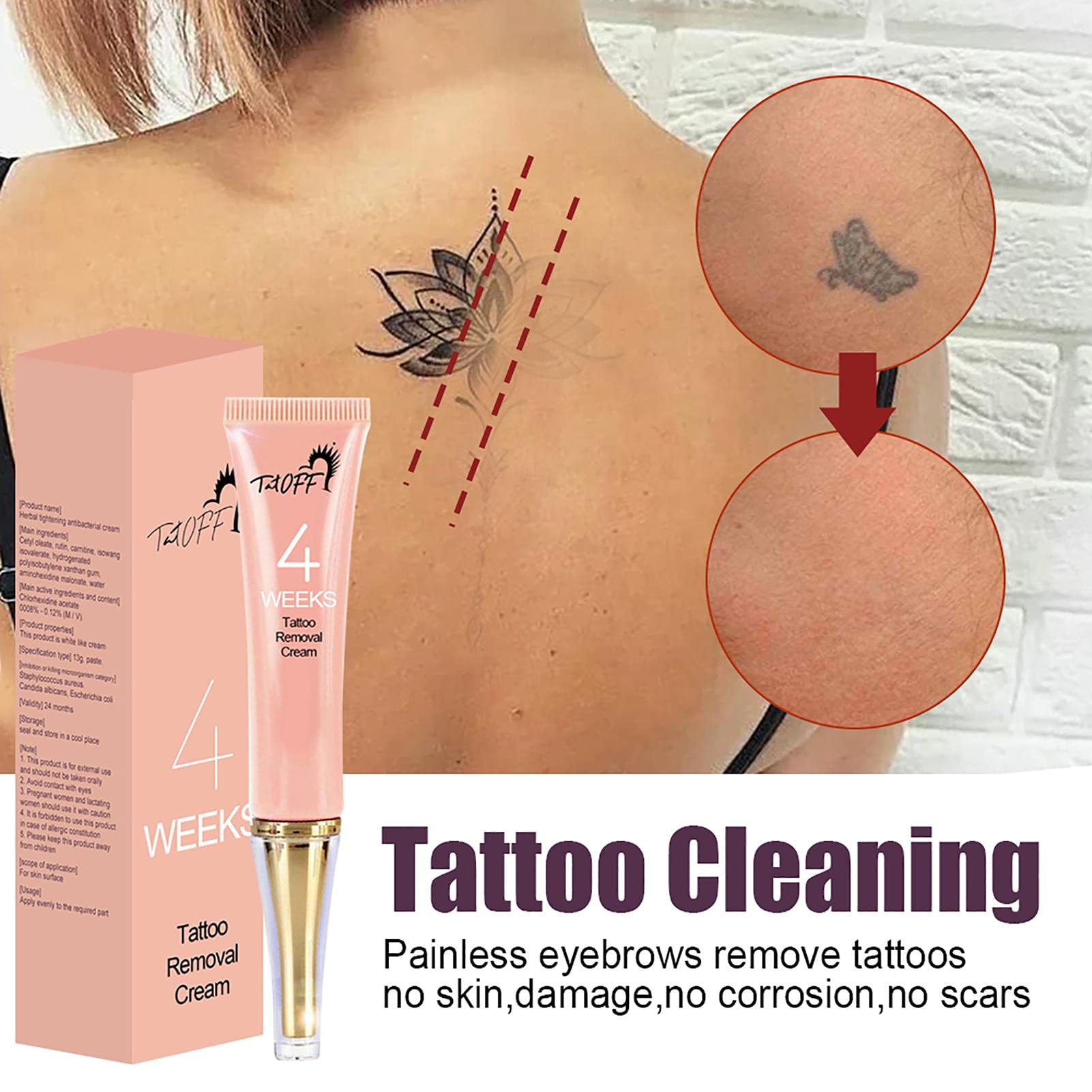 técnicas de remoção de tatuagem