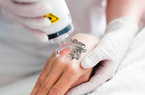 clínicas de remoção de tatuagem baratas