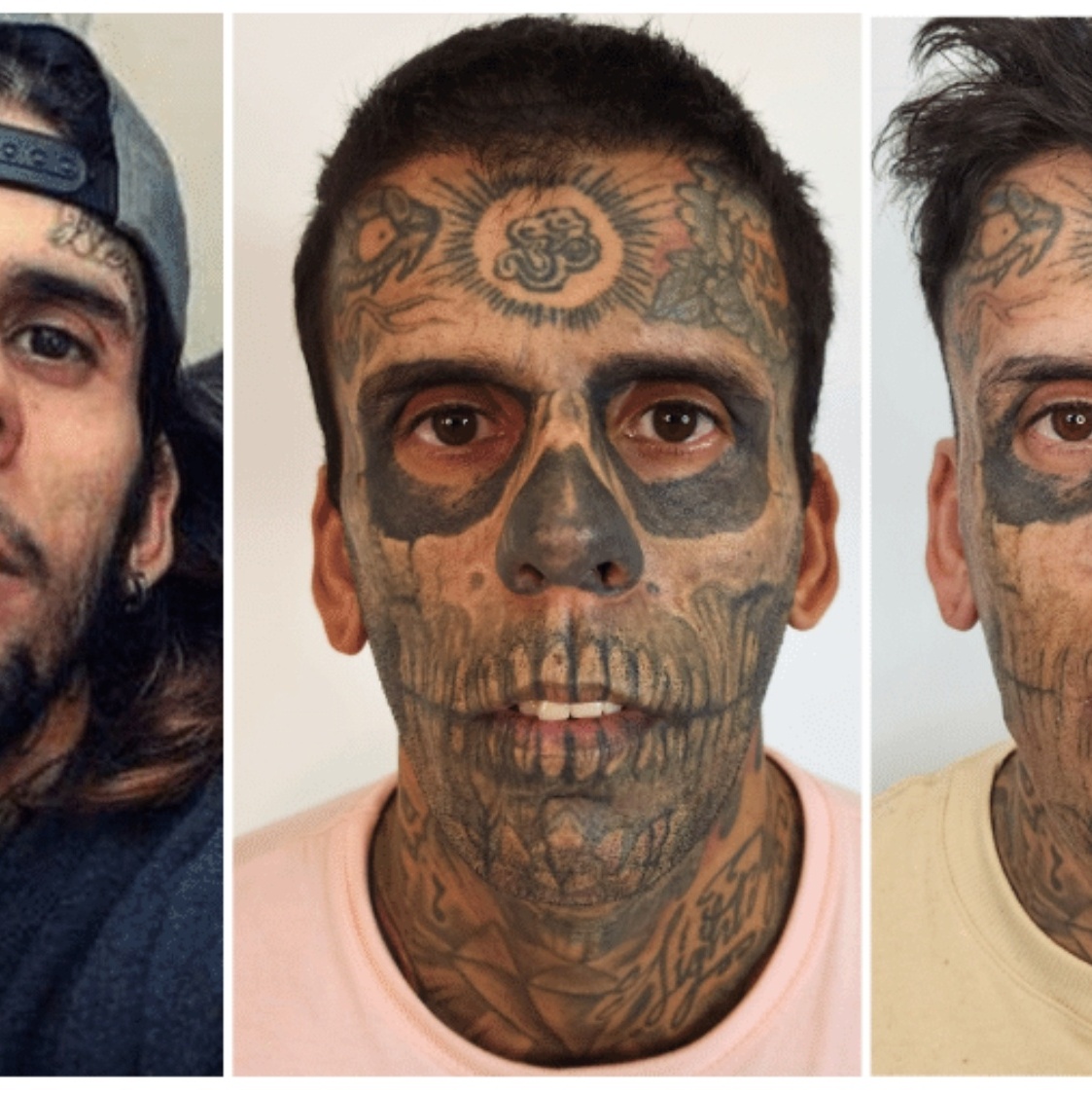 quanto custa apagar tatuagem
