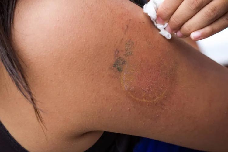 preço remoção tatuagem 2026