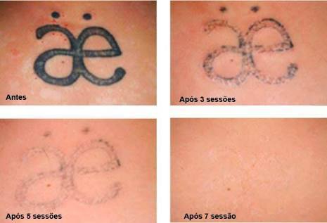 custo médio remoção tatuagem a laser