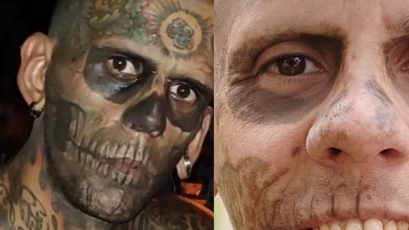 quanto custa apagar tatuagem