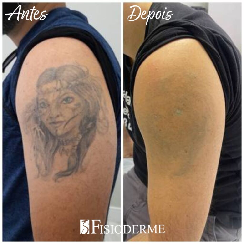 valor sessão remoção tatuagem