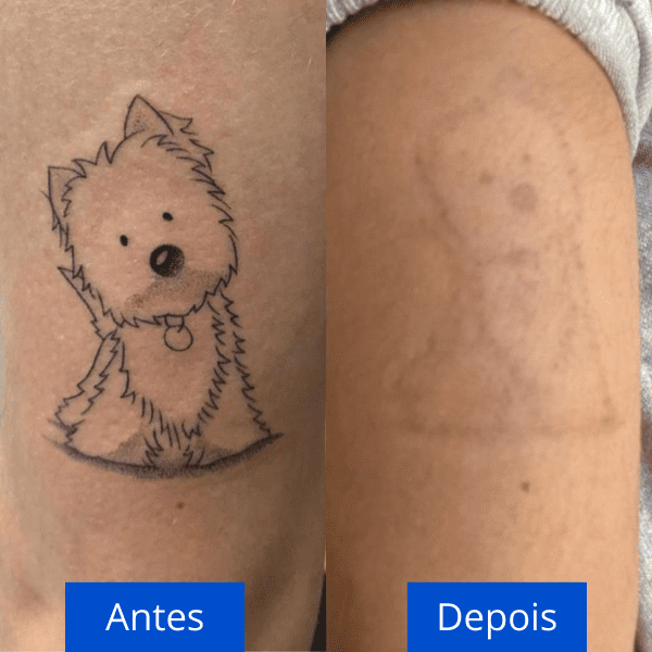 técnicas de remoção de tatuagem