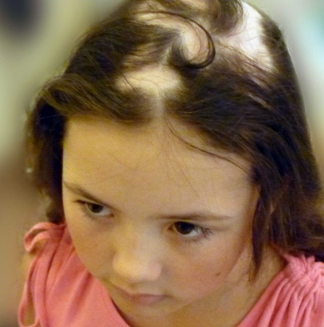 queda de cabelo infantil