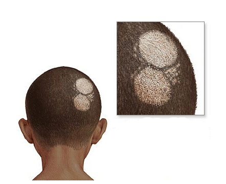 Alopecia Areata Infantil: O Que os Pais Precisam Saber