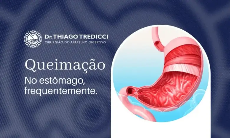 Queimacao No Estomago