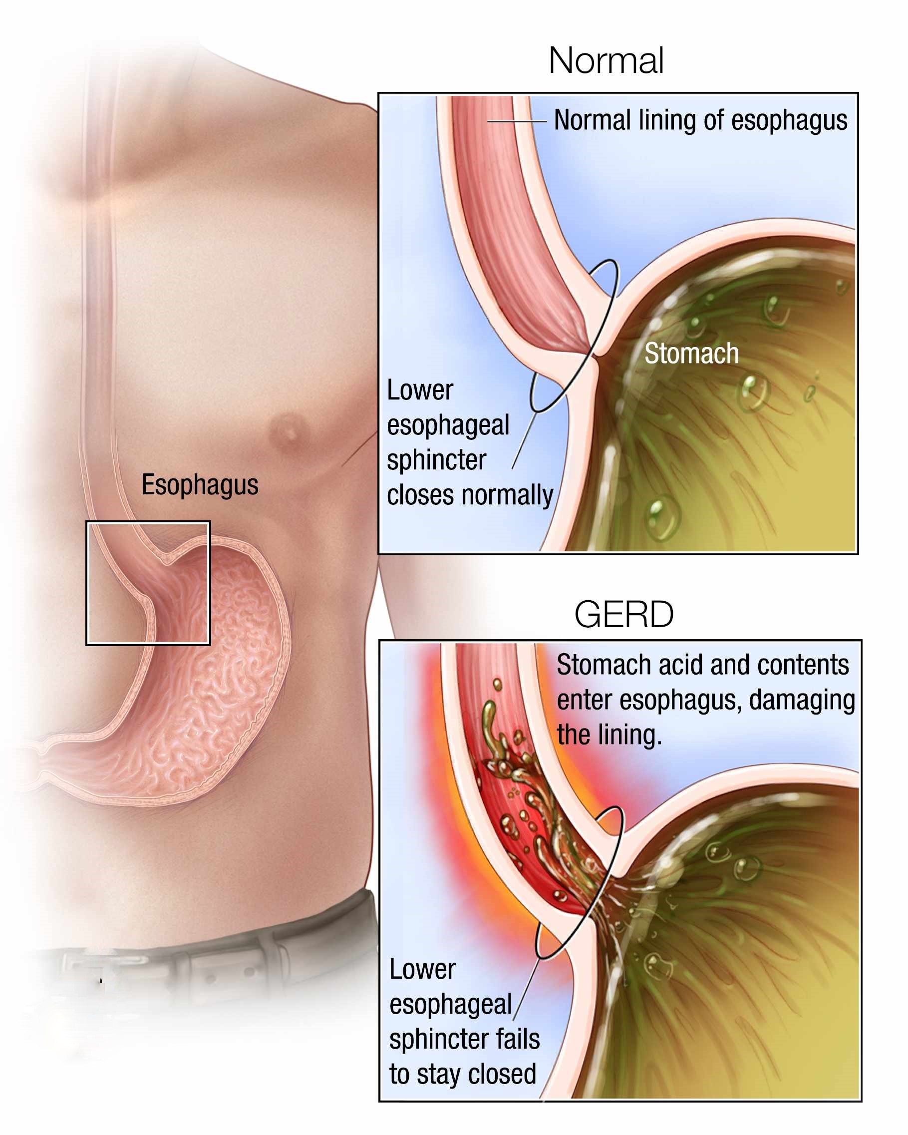 Queimacao No Estomago