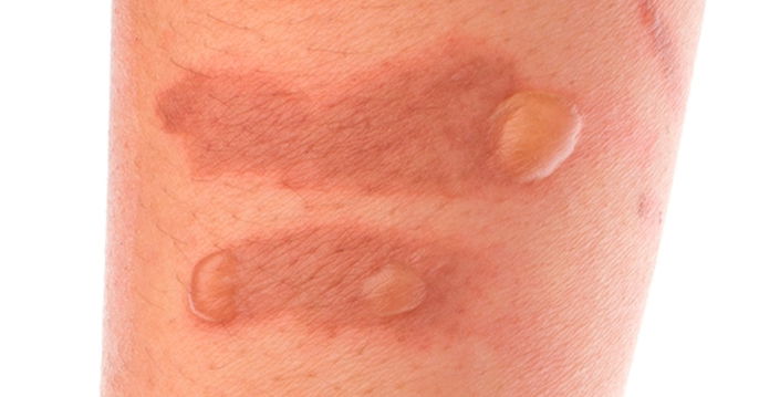 5 ideias de títulos:
1. Queimadura de Cera: Guia Completo de Primeiros Socorros e Cuidados Pós-Tratamento
2. Evite Manchas e Cicatrizes: O Que Fazer e Não Fazer Após Queimadura de Cera
3. Pele Sensível Pós-Depilação: Como Tratar Queimaduras de Cera Rapidamente
4. Alívio Imediato e Recuperação: Dicas Essenciais para Queimaduras de Cera
5. Quando Procurar um Médico: Sinais de Alerta em Queimaduras de Cera