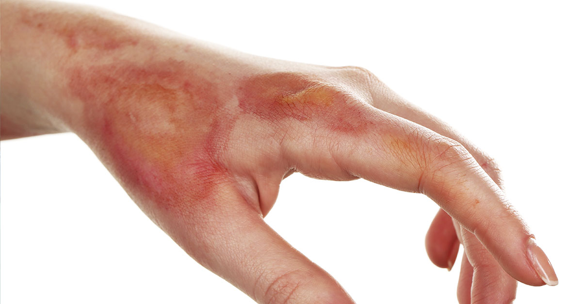 5 ideias de títulos:
1. Queimadura de Cera: Guia Completo de Primeiros Socorros e Cuidados Pós-Tratamento
2. Evite Manchas e Cicatrizes: O Que Fazer e Não Fazer Após Queimadura de Cera
3. Pele Sensível Pós-Depilação: Como Tratar Queimaduras de Cera Rapidamente
4. Alívio Imediato e Recuperação: Dicas Essenciais para Queimaduras de Cera
5. Quando Procurar um Médico: Sinais de Alerta em Queimaduras de Cera