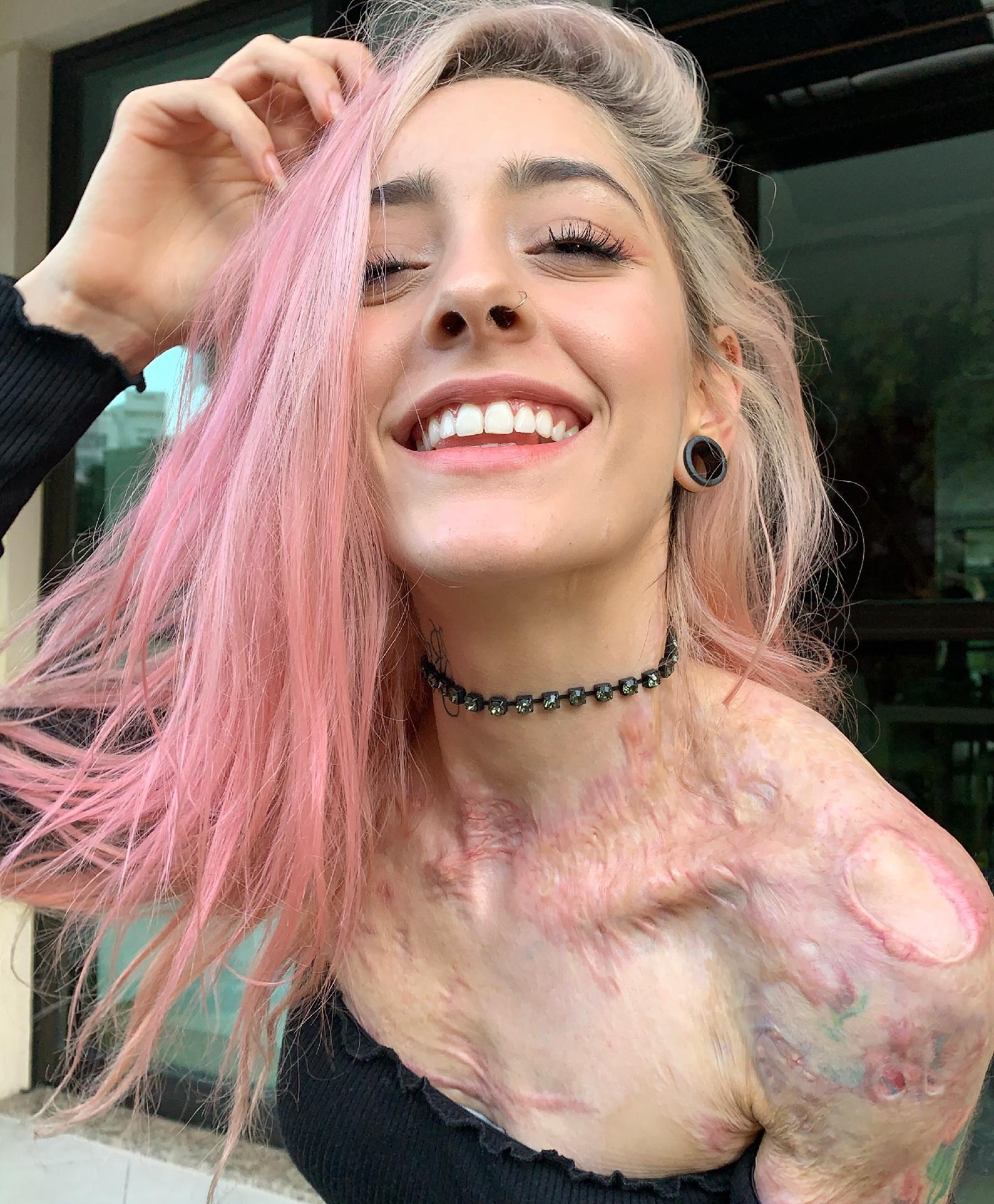 queimadura com cera quente