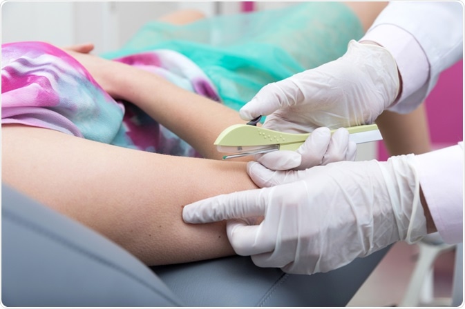 Quem pode usar o implante pelo SUS