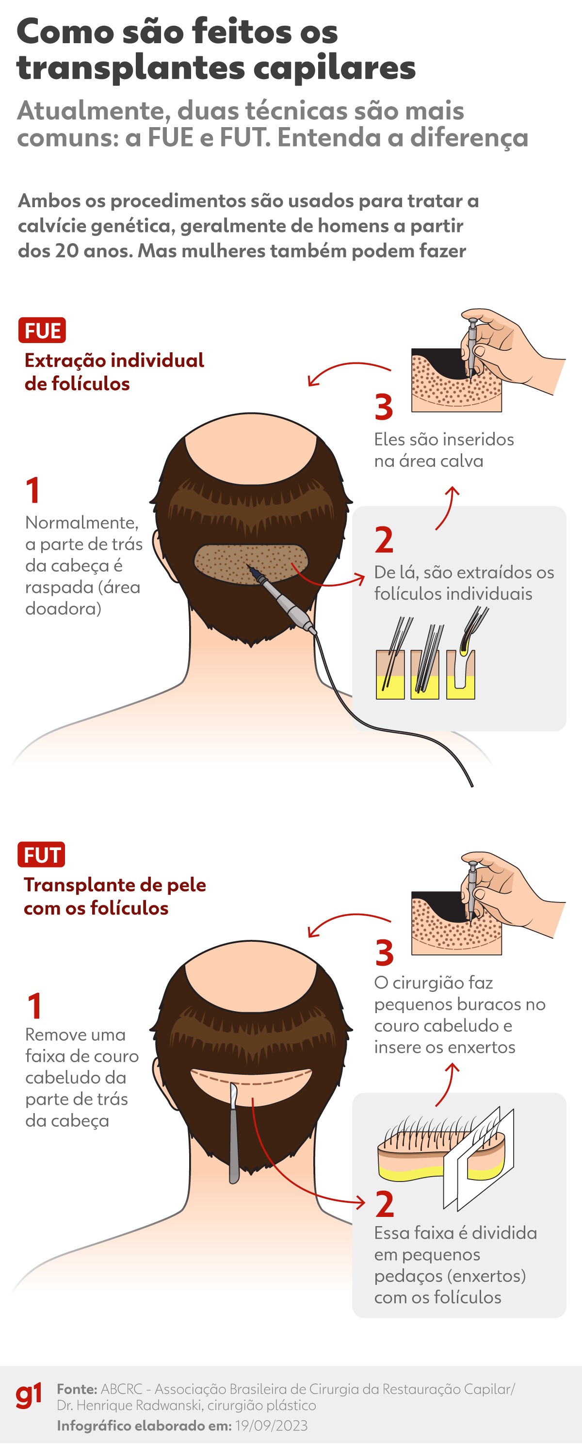 implante capilar pelo SUS é possível?