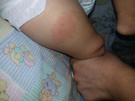 Pentavalente SUS vs. Privada: Quais as Diferenças e Implicações?