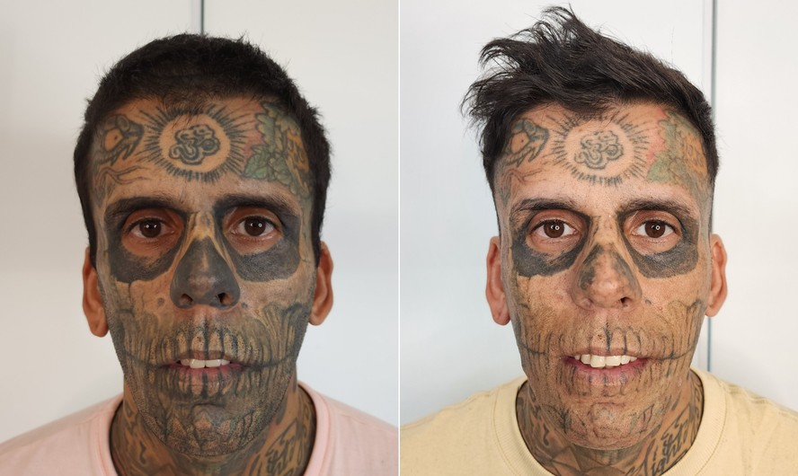 remoção de tatuagem a laser