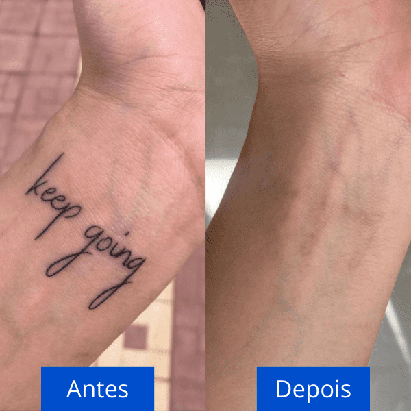 custo remoção tatuagem