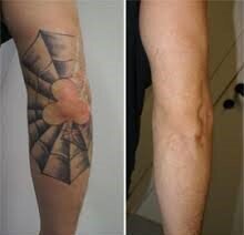 clarear tatuagem para cover-up