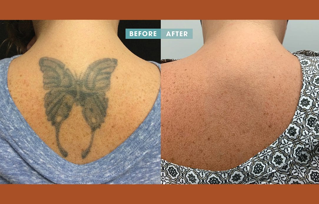 dermatologista remoção tatuagem