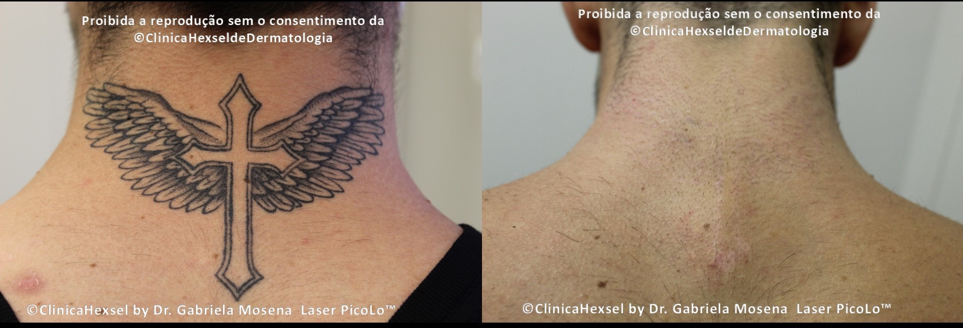 remoção de tatuagem caseira funciona