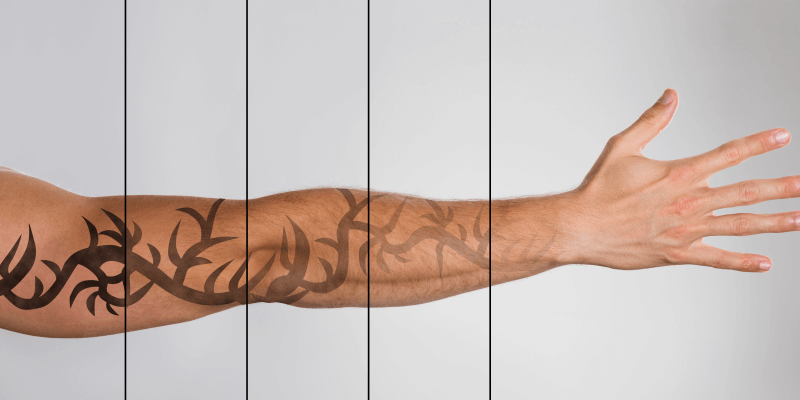 tempo de recuperação remoção tatuagem