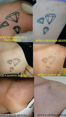 quantas sessões para remover tatuagem