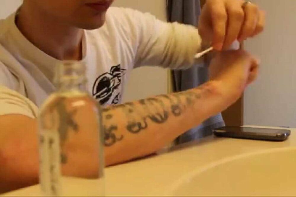 cuidados pós remoção de tatuagem